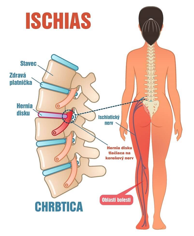 Ako odblokovať sedací nerv (ischias): 10 jednoduchých cvikov