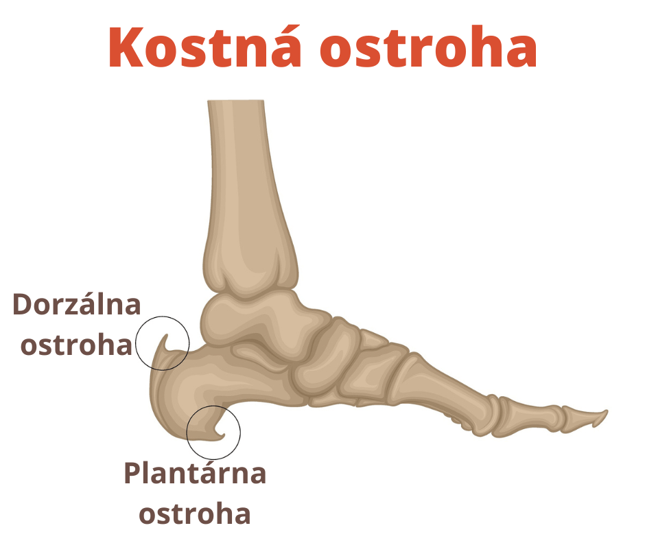 Kostné ostrohy: Príznaky, príčiny a liečba