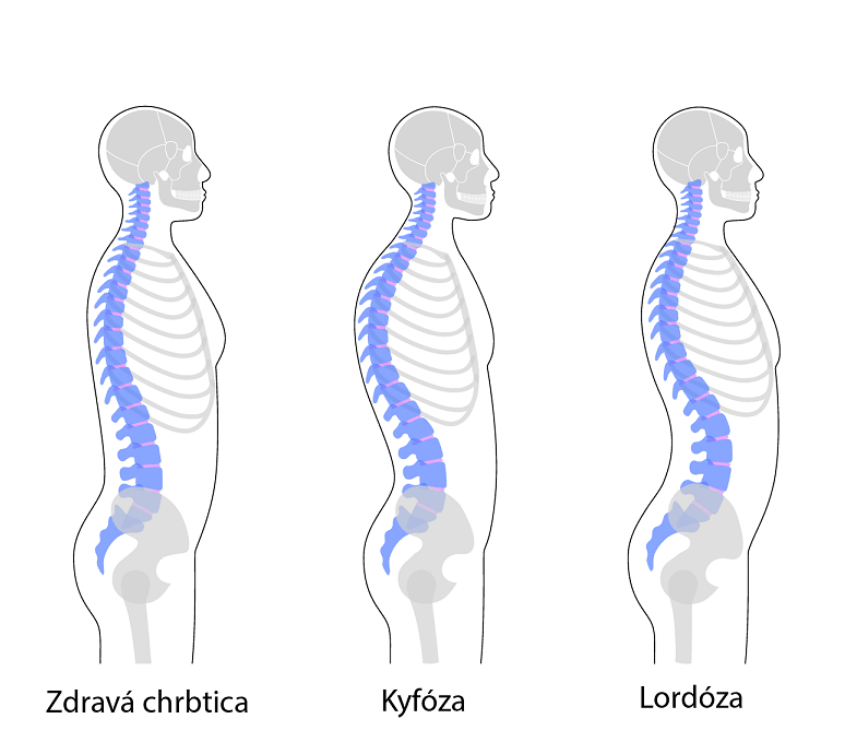 Kyfóza (okrúhly chrbát): Príznaky, príčiny a liečba