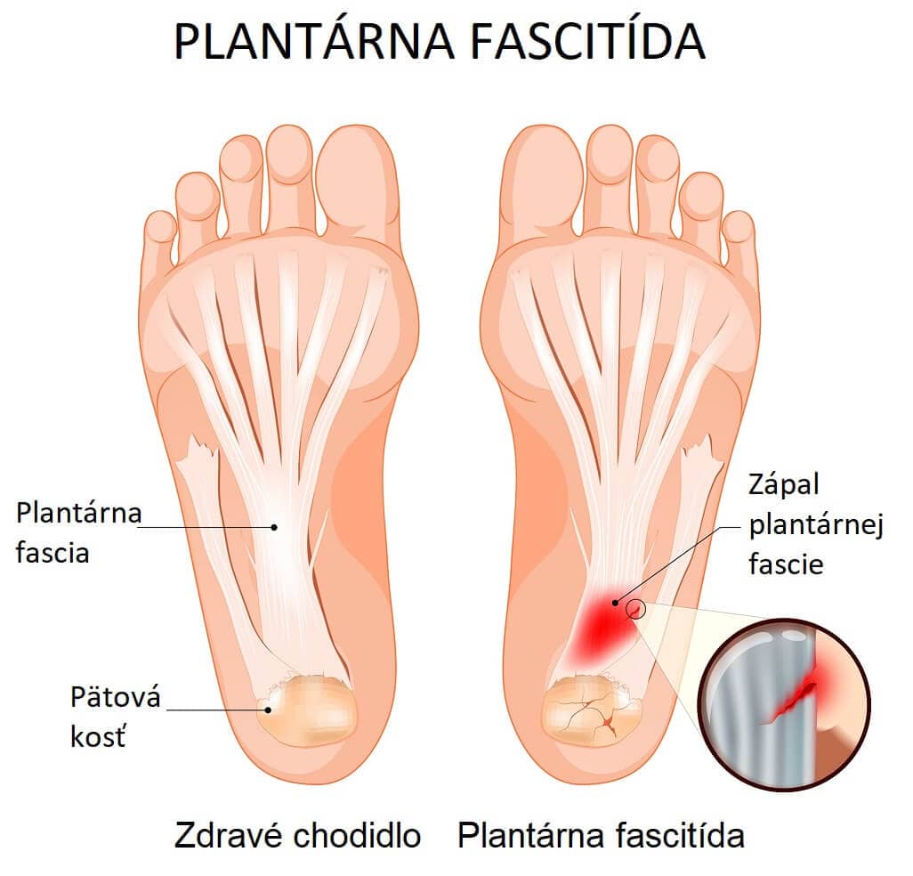 Plantárna fascitída: Príznaky, príčiny a liečba