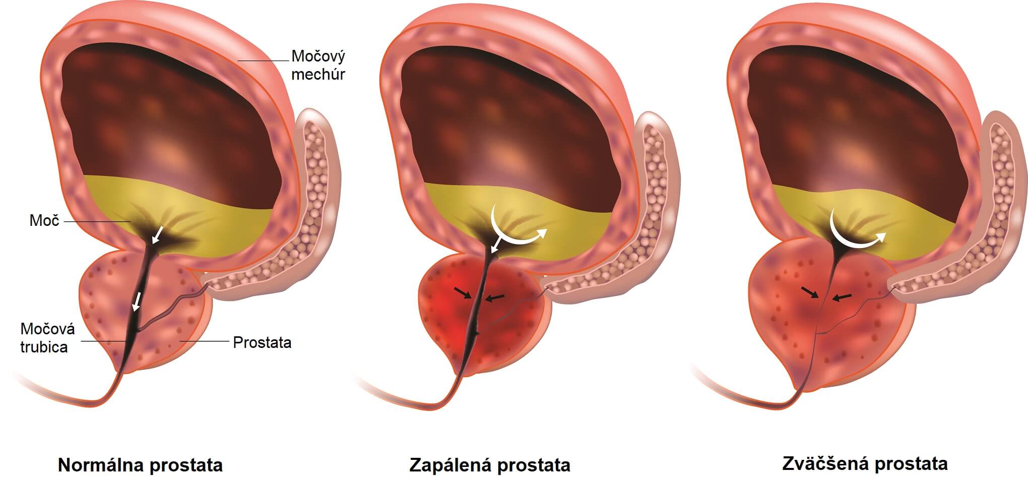 Prostatitída (zápal prostaty): Príznaky, príčiny a liečba