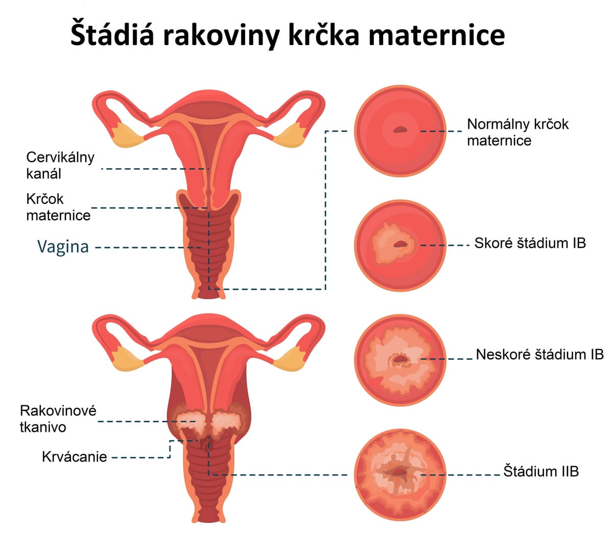 Rakovina krčka maternice: Príznaky, príčiny a liečba