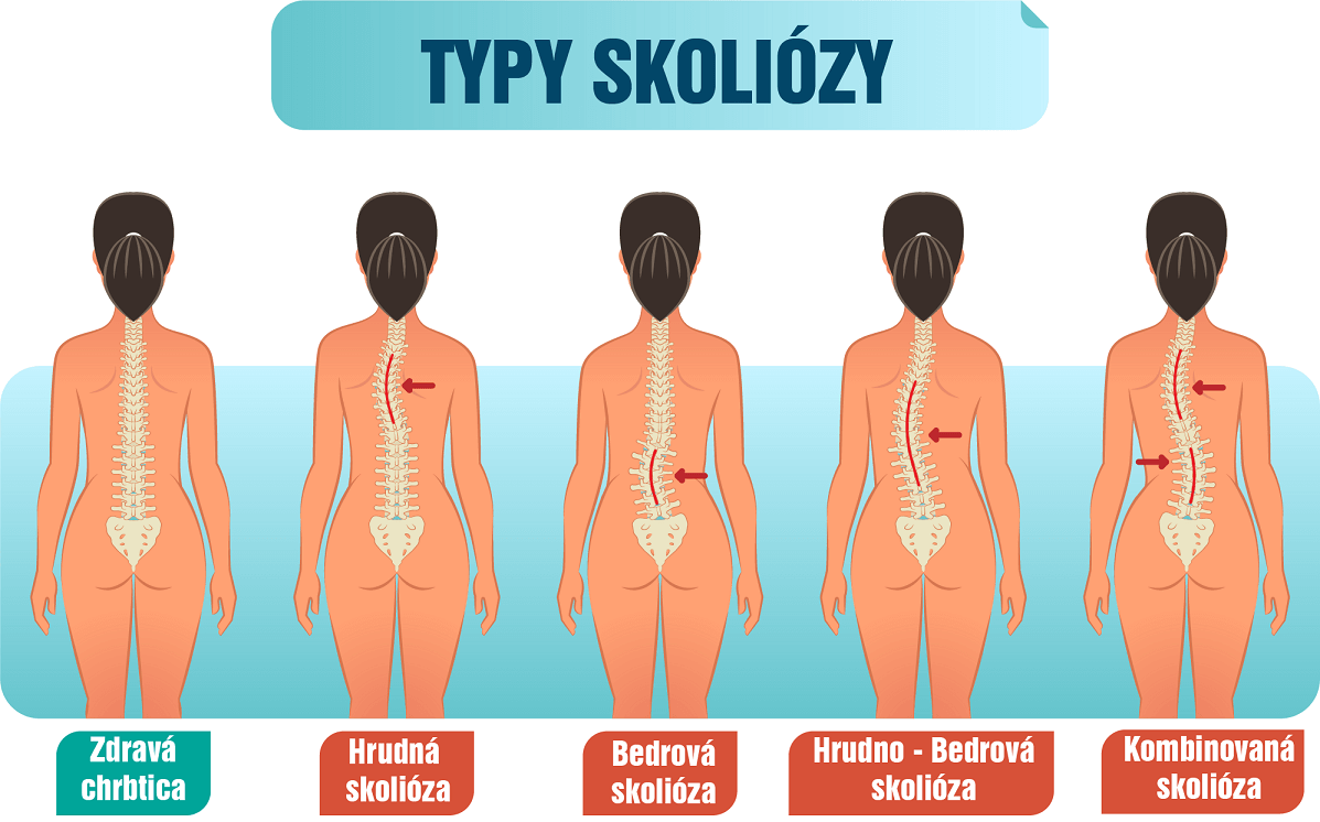 Skolióza: Príznaky, príčiny a liečba