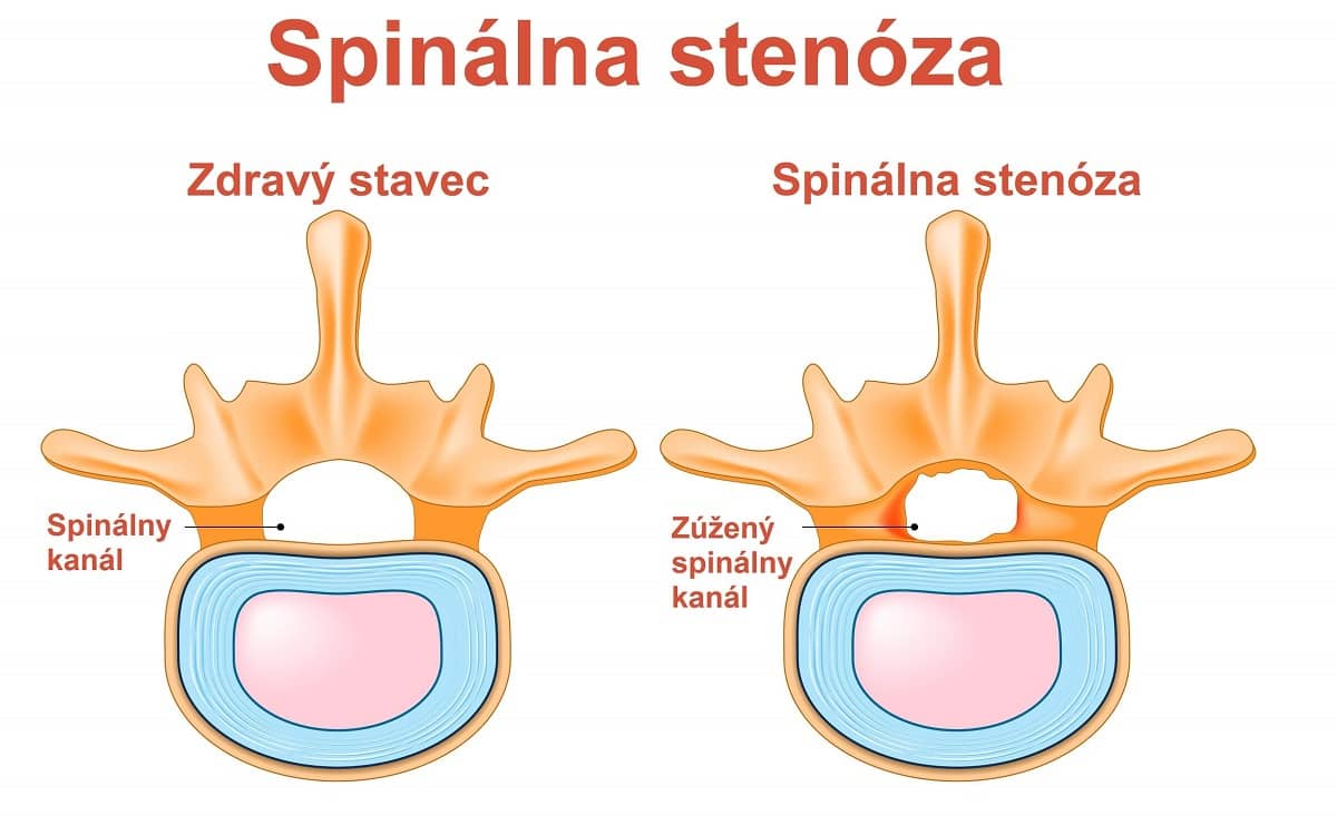 Spinálna stenóza: Príznaky, príčiny a liečba