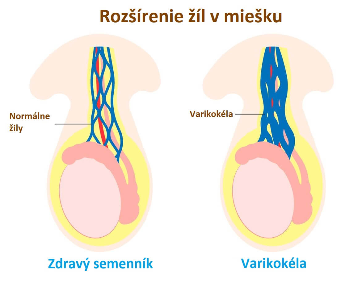 Varikokéla: Príznaky, príčiny a liečba