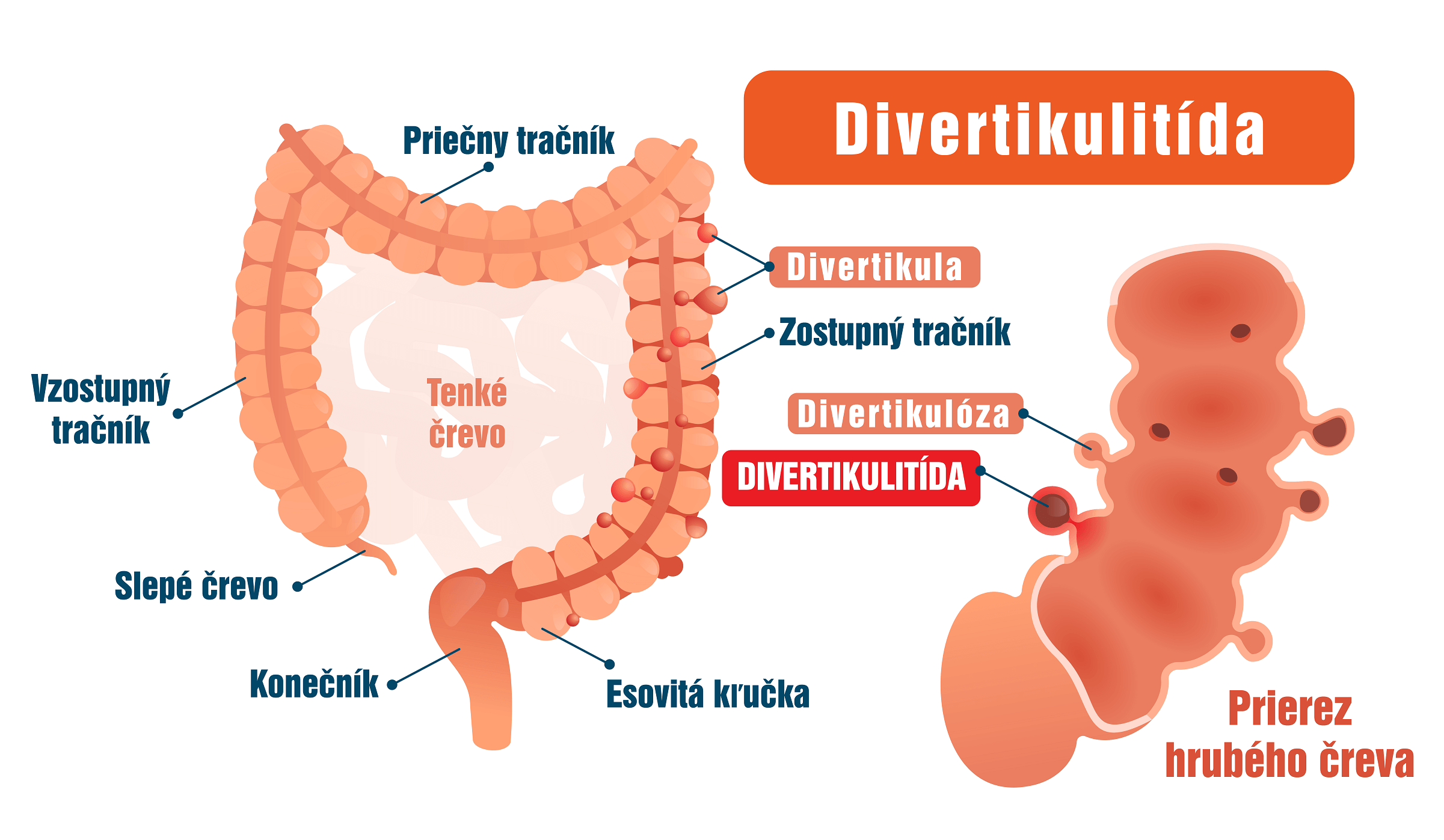 Divertikulitida