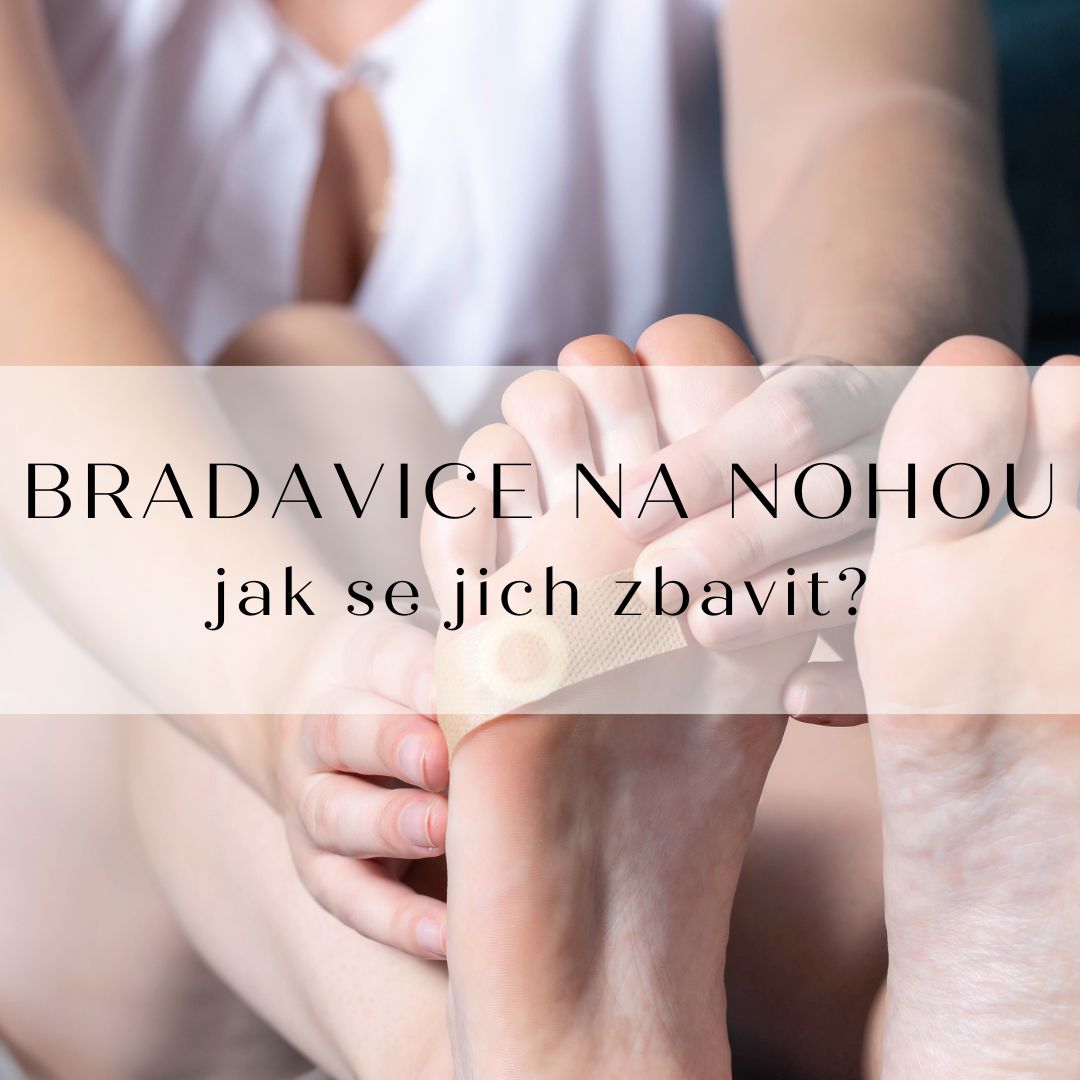 Jak se zbavit bradavic na nohou?