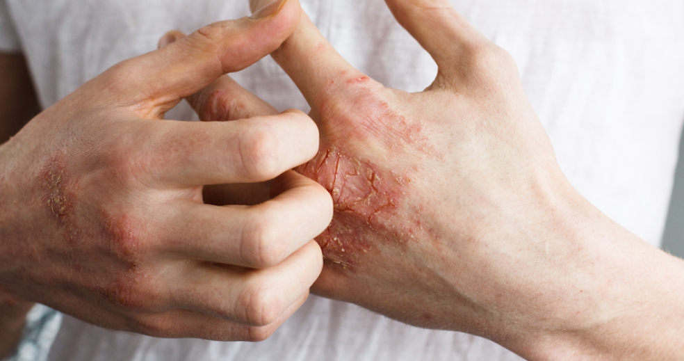 ATOPICKÝ EKZÉM - PŘÍČINY A CO NA NĚJ POMÁHÁ