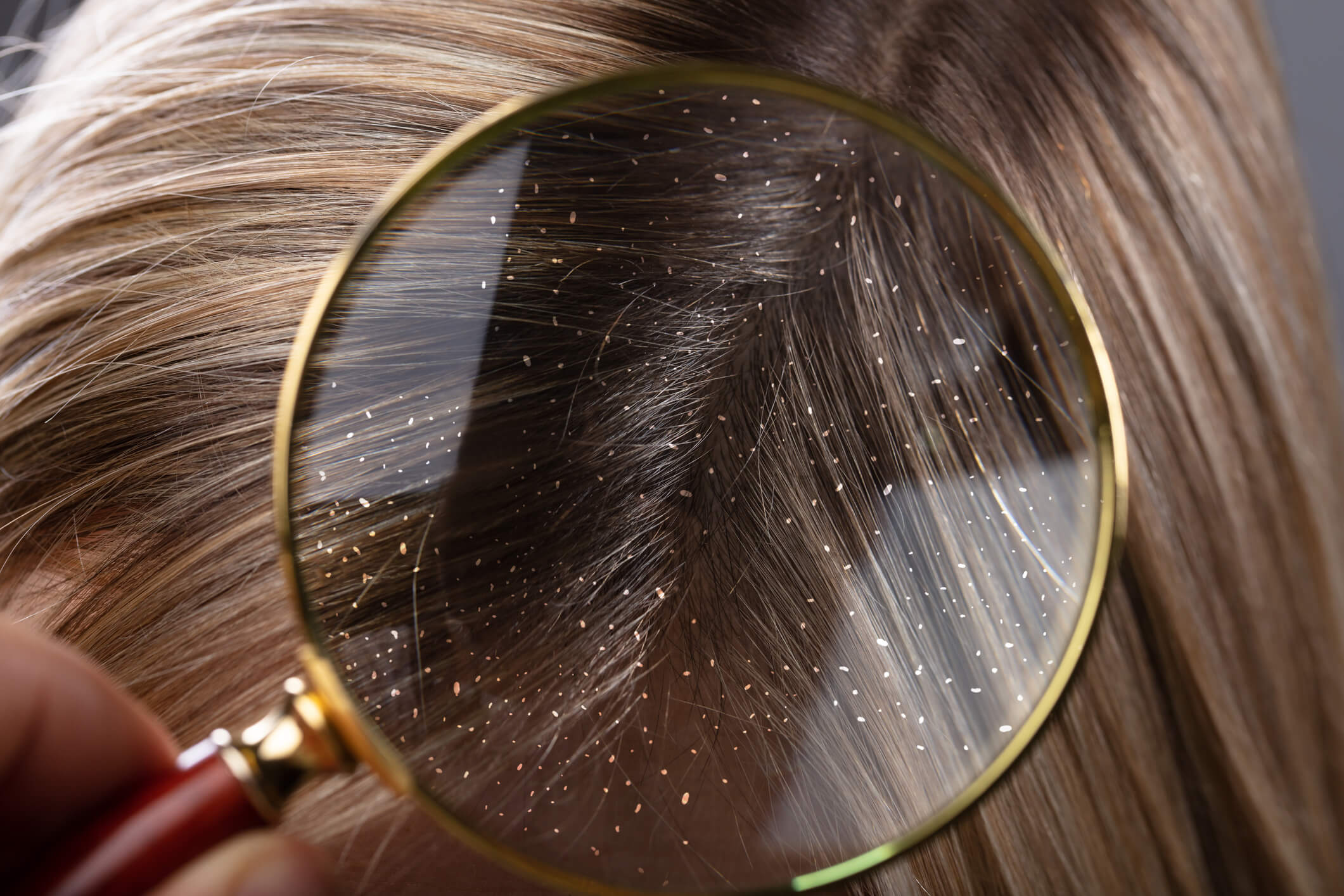 Ako sa zbaviť lupín vo vlasoch?