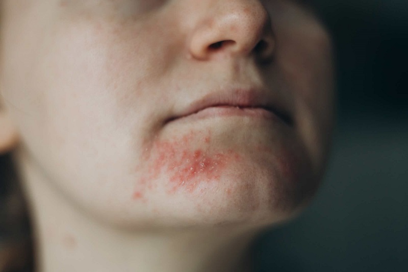 Ako sa starať o pokožku so sklonom k periorálnej dermatitíde