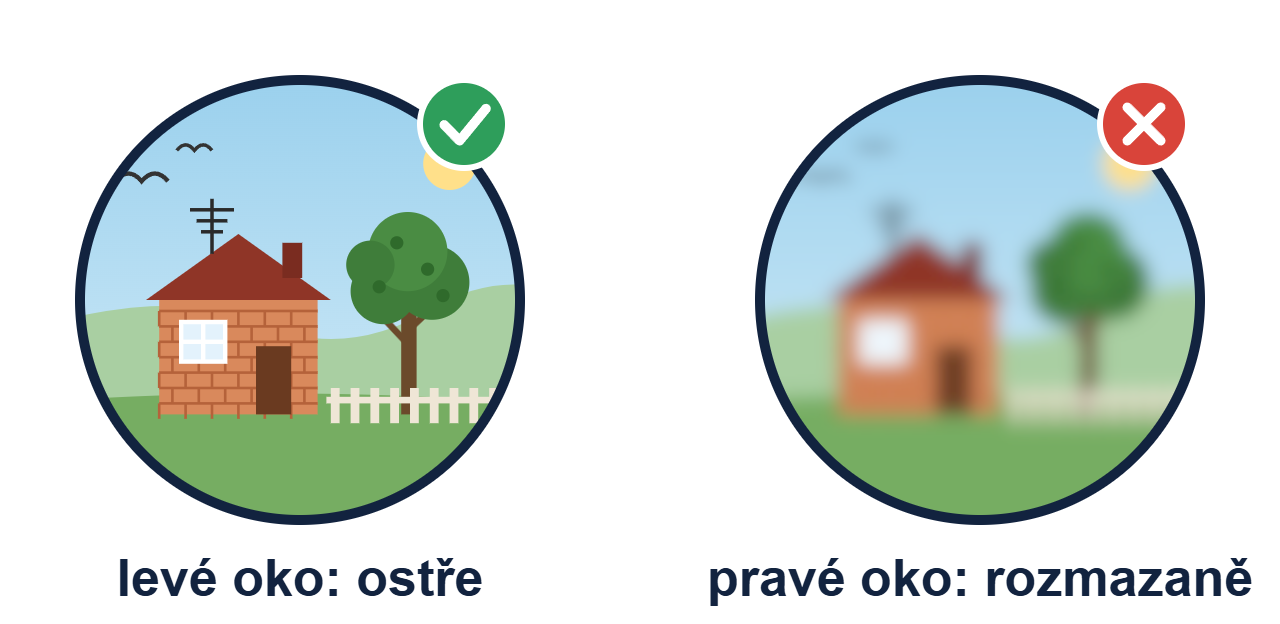 Pohled dalekohledem bez nastavené dioptrické korekce: levé oko vidí ostře, pravé rozmazaně