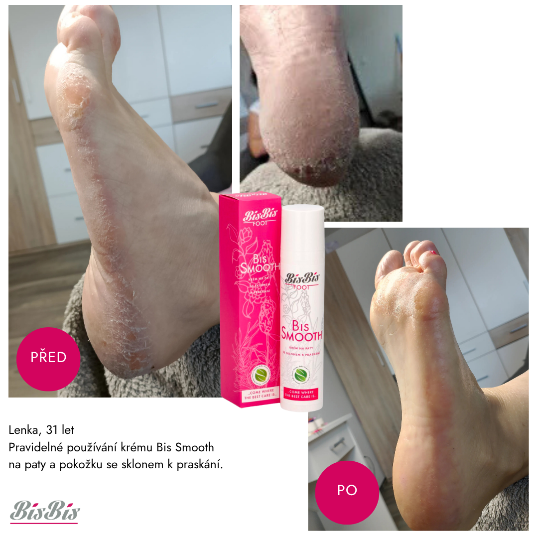 Viditelná změna díky Bis Smooth: Popraskané vs. hebké paty