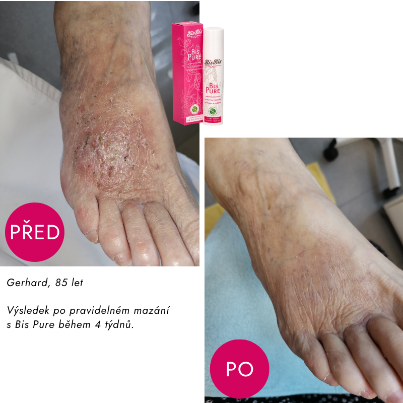 Změna po 4 týdnech díky Bis Pure u 85letého klienta