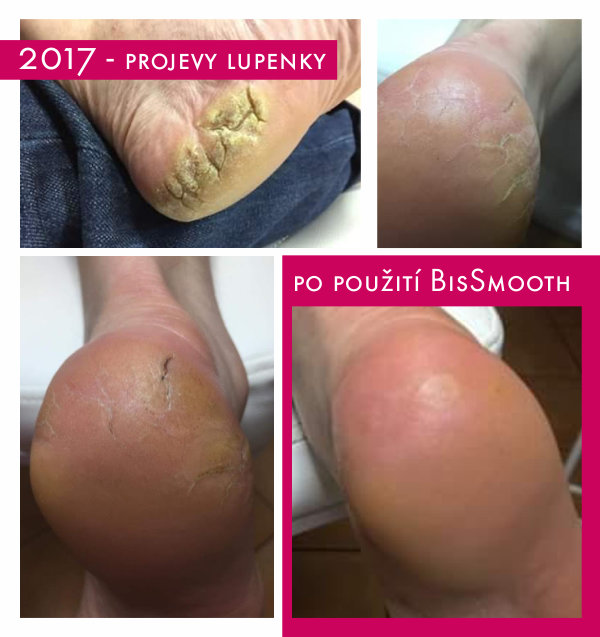 Bis Smooth a projevy lupénky