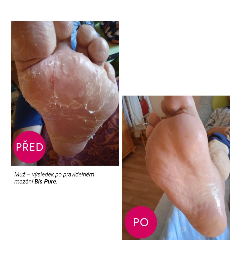 Bis Pure pomohl při dlouhotrvající mykóze