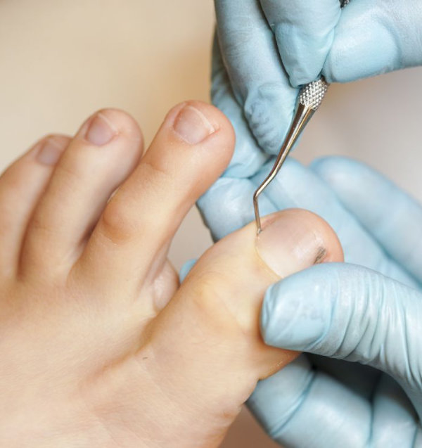 Mykóza  nehtů - odborně onychomóza