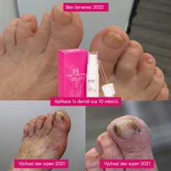 JAK SE ZBAVIT PLÍSNĚ NA NEHTECH. PODÍVEJTE SE, CO DOKÁŽE BIS NAIL TINCTURE
