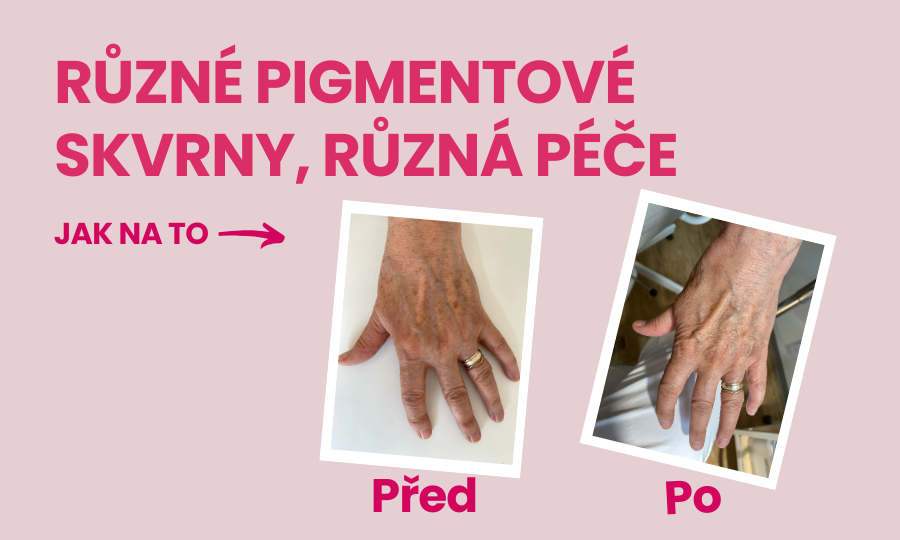 Pigmentové skvrny nejsou všechny stejné a proto potřebují různou péči