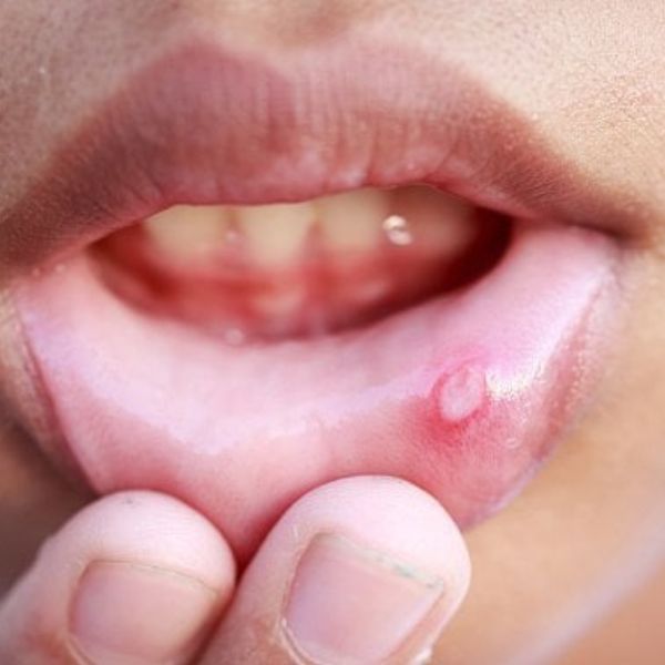Afty v ústech, v krku a na jazyku - nejrychlejší léčba, 12 babských rad a prevence