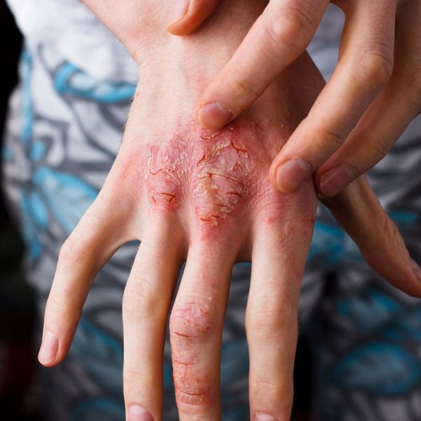 Atopický ekzém: Najděte konkrétní spouštěč a vyhněte se mu 🚫