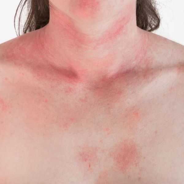 Histaminová intolerance a jak ji ustát ve zdraví