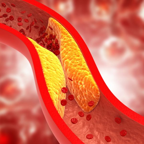 Jak snížit cholesterol dlouhodobě i rychle? Co jíst a jak změnit životosprávu?