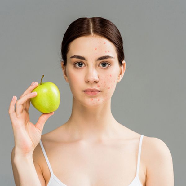 Léčba akné: Jak docílit krásné pleti pomocí vhodné stravy?