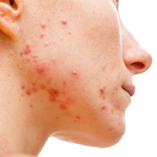 9 mýtů a faktů o akné. Tohle si myslí dermatoložky