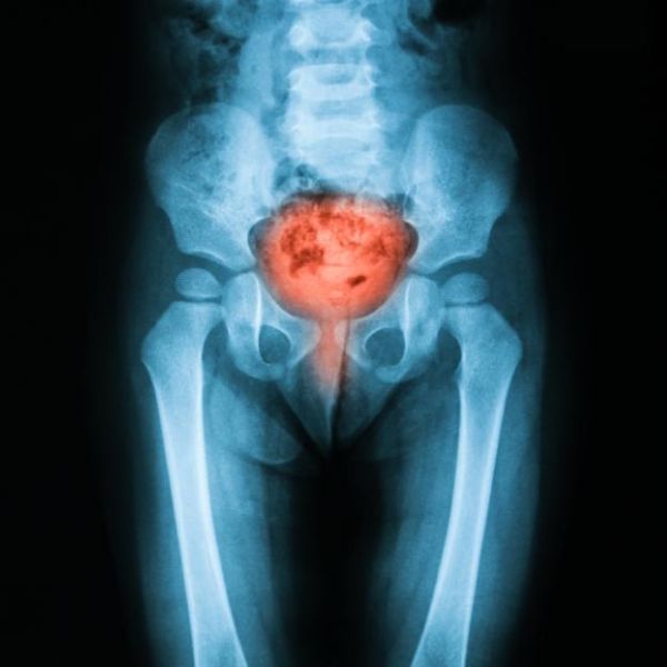 Zánět močového měchýře - 10 osvědčených preventivních tipů