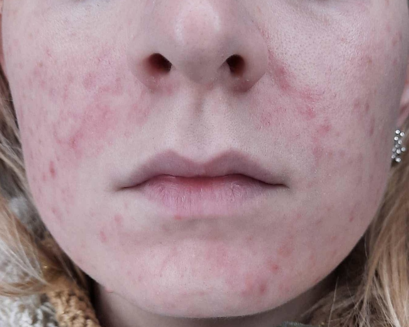 Jak na periorální dermatitidu?