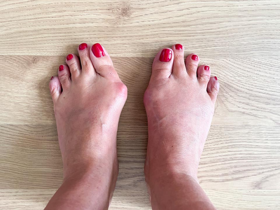 Hallux valgus: Čo ho spôsobuje a ako mu predísť?