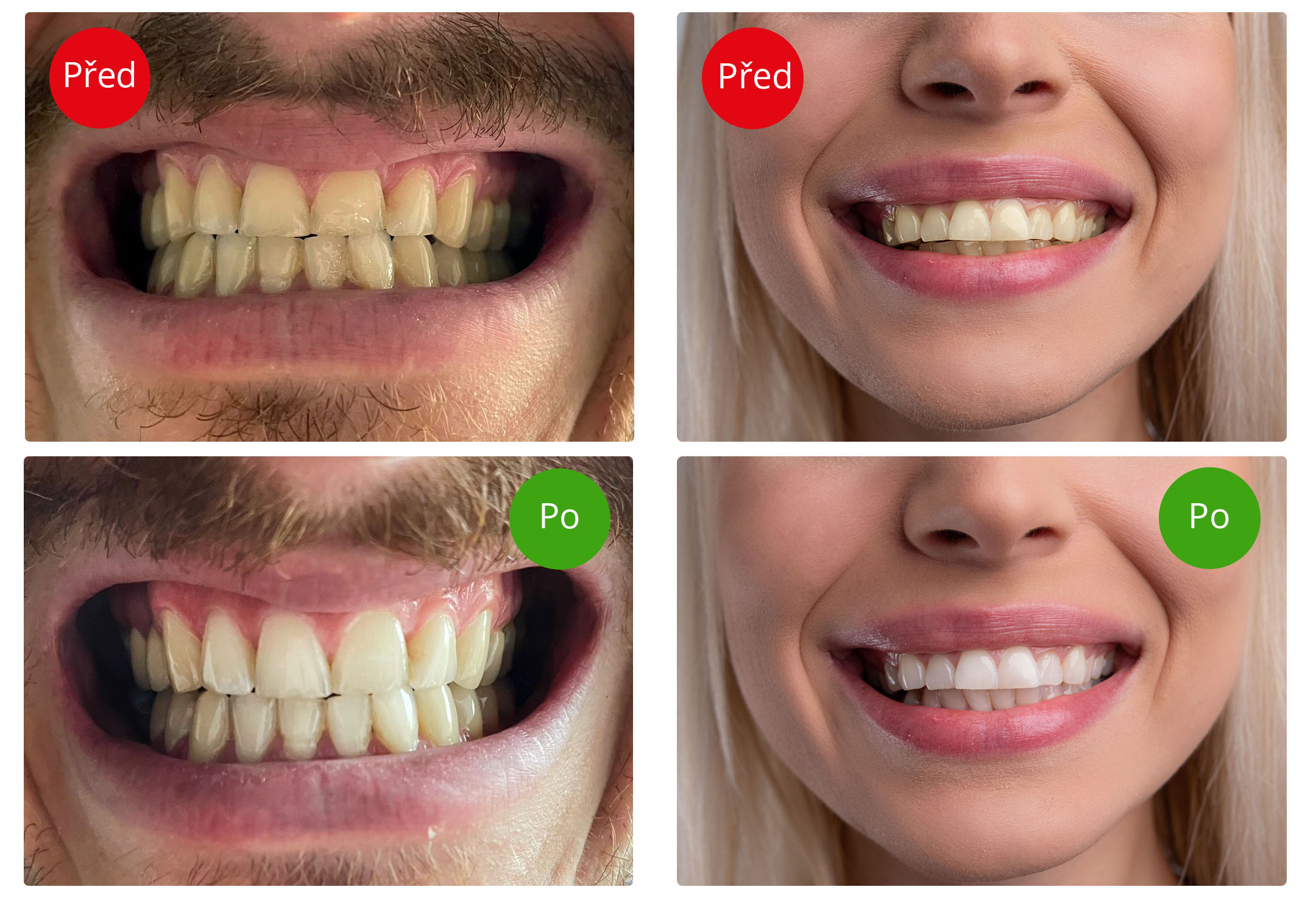 Blight Smile, Světelná sada pro bělení zubů Obrázek