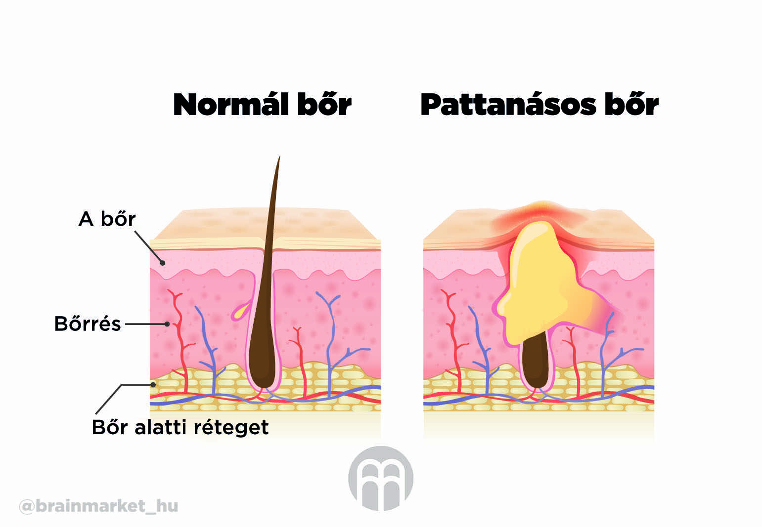 normalni_plet_vs_akne_infografika_brainmarket_hu