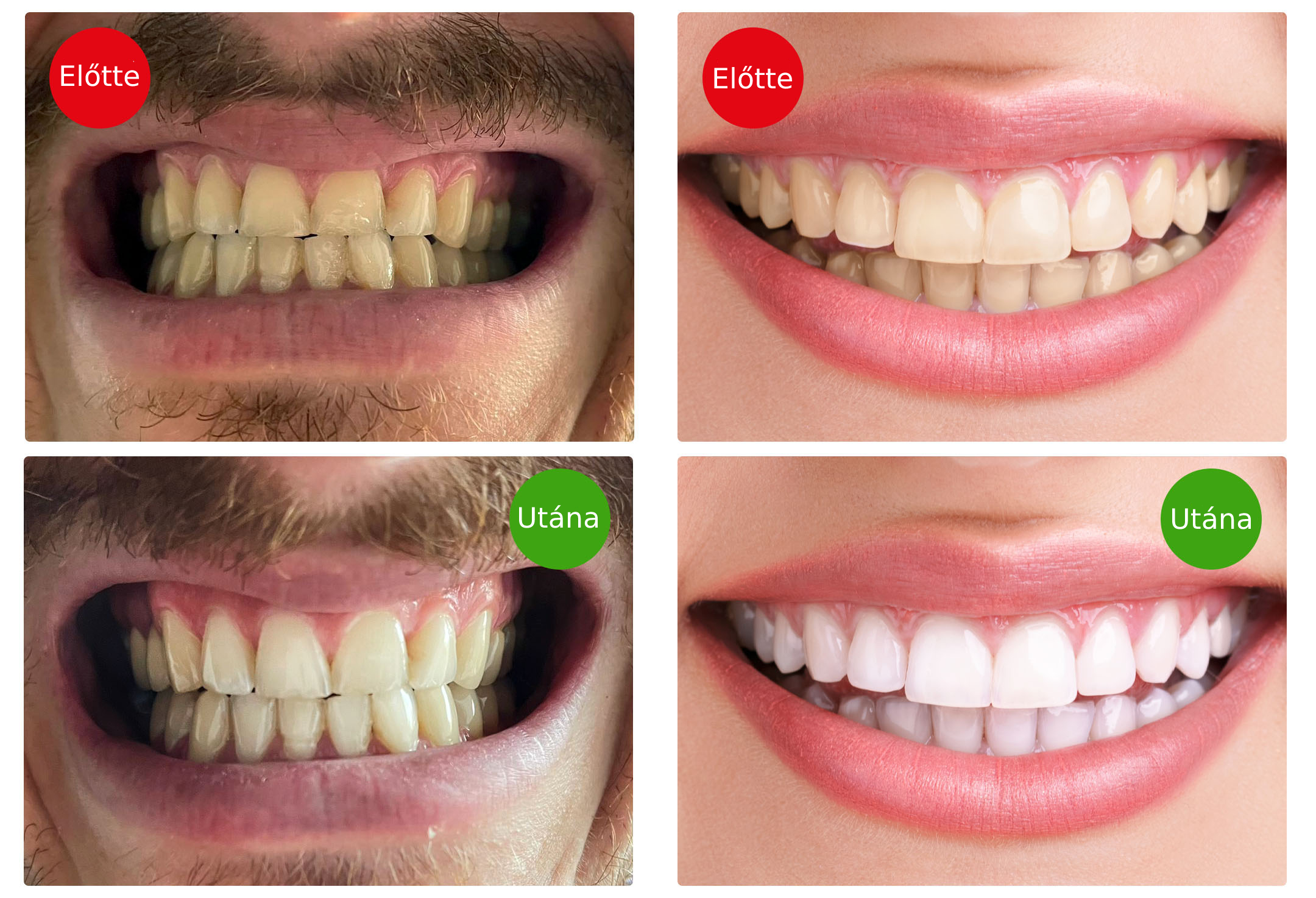 Blight Smile, Světelná sada pro bělení zubů Obrázek