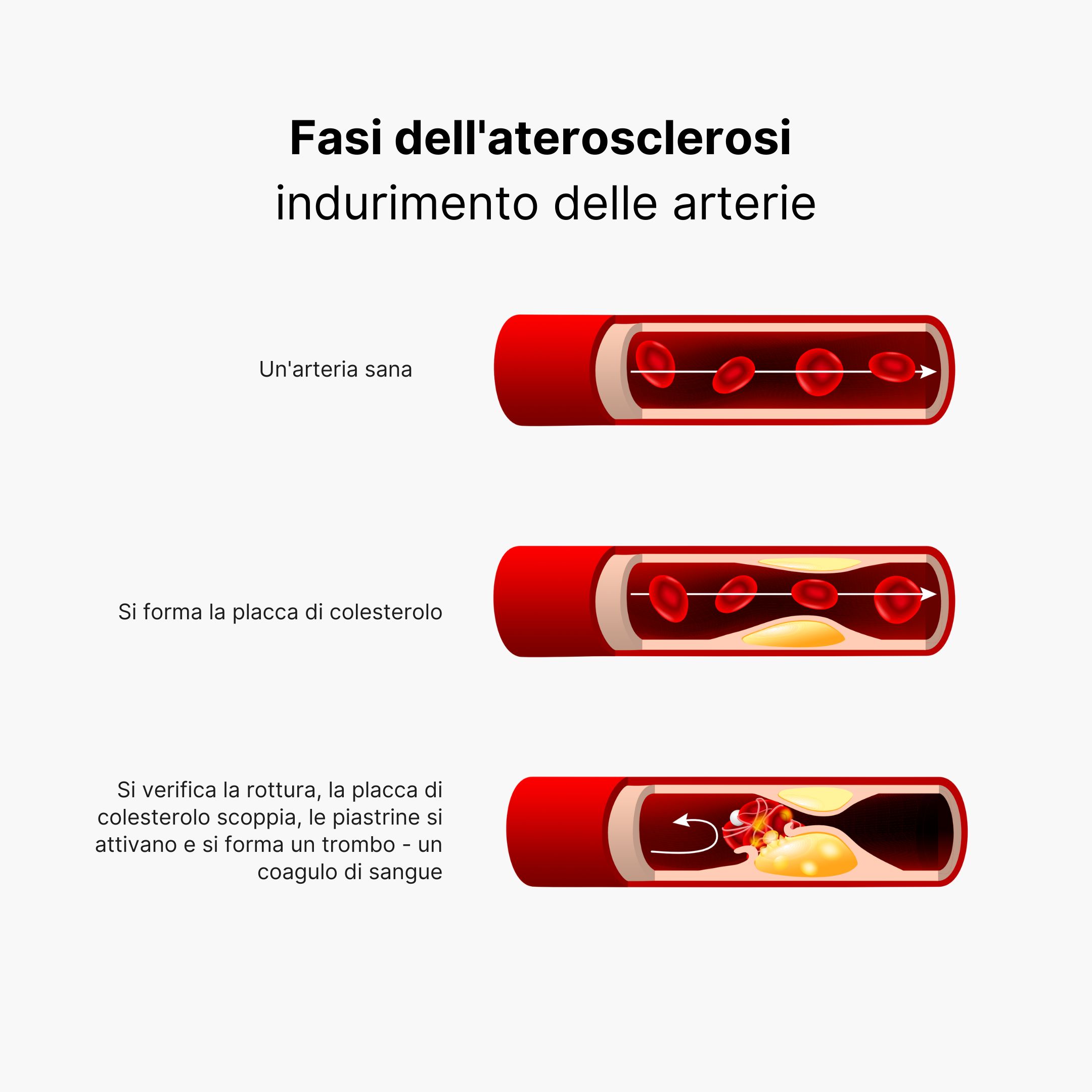 (Italština) Arterioskleróza 
