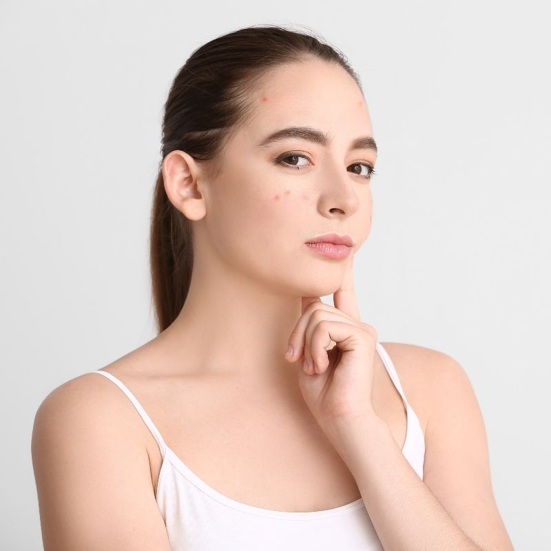 Prírodná starostlivosť o akné: Čo vyskúšať a čomu sa vyhnúť?