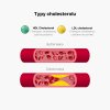 (Slovenčina) Typy cholesterolu