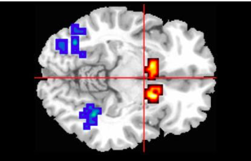 Can Hemp Help with Psychosis? New Research Suggests CBD May Offer Hope