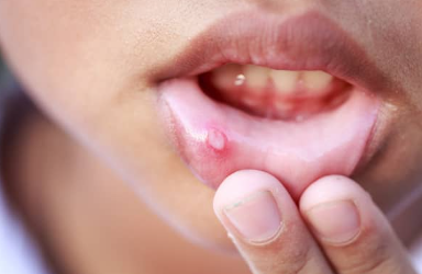 How CBD Can Help Treat Painful Aphthous Ulcers
