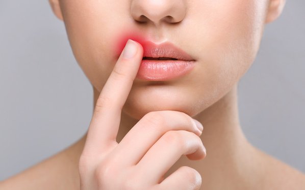 Jak pozbyć się opryszczki?