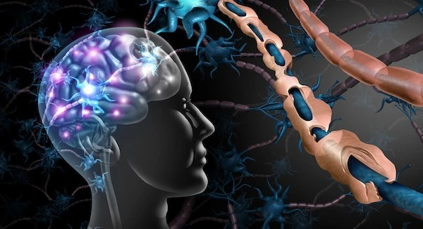 Multiple Sclerosis – What are the symptoms and treatment?