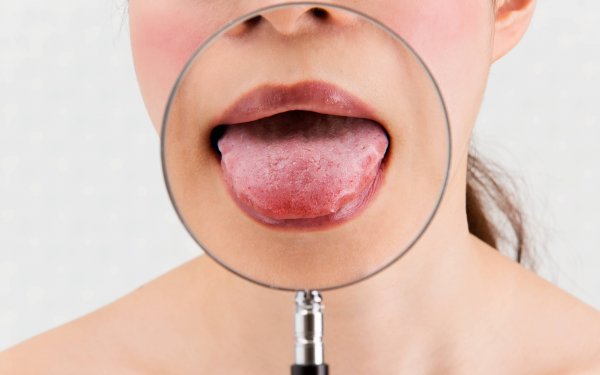 afty-przyczyny-i-leczenie