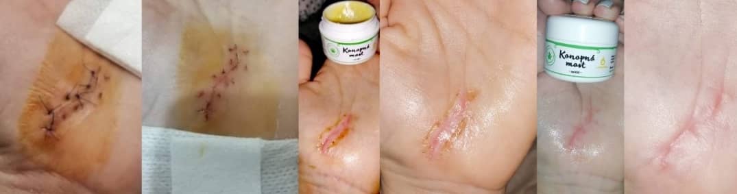 scar-healing-with-hemp-ointment-with-marigold
