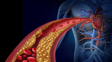 Hogyan kezelhető a magas koleszterinszint?