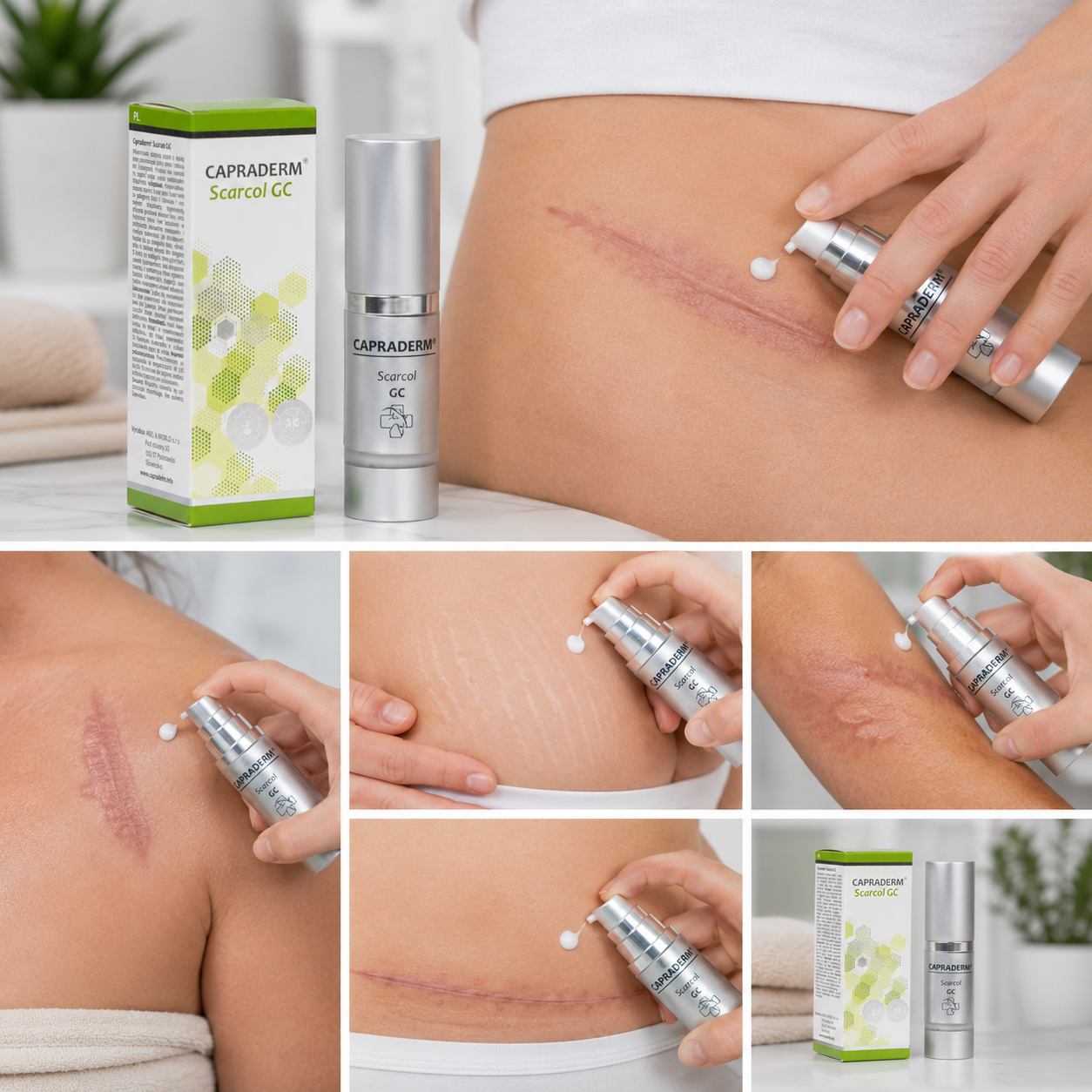 Capraderm Scarcol GC pri jazvách, striách a popáleninách