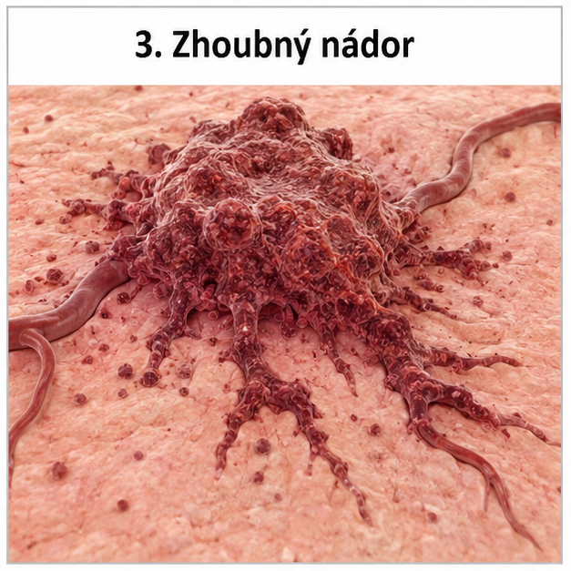 Zhoubný nádor