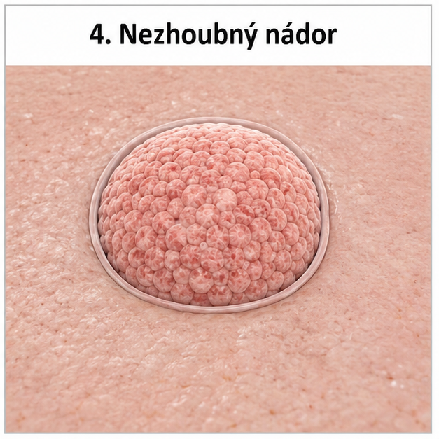 Nezhoubný nádor