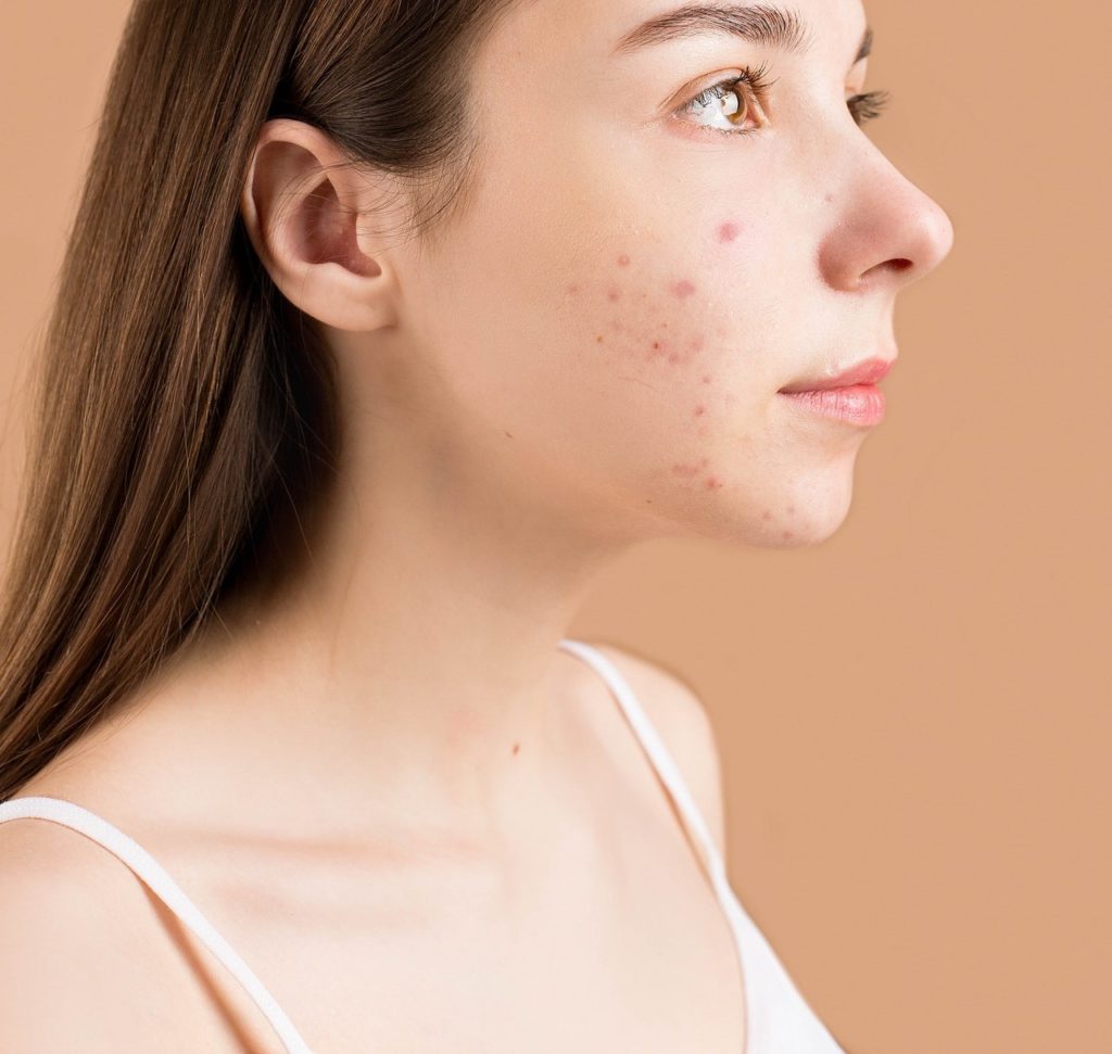 CBD olej je šance, jak se rychle zbavit akné