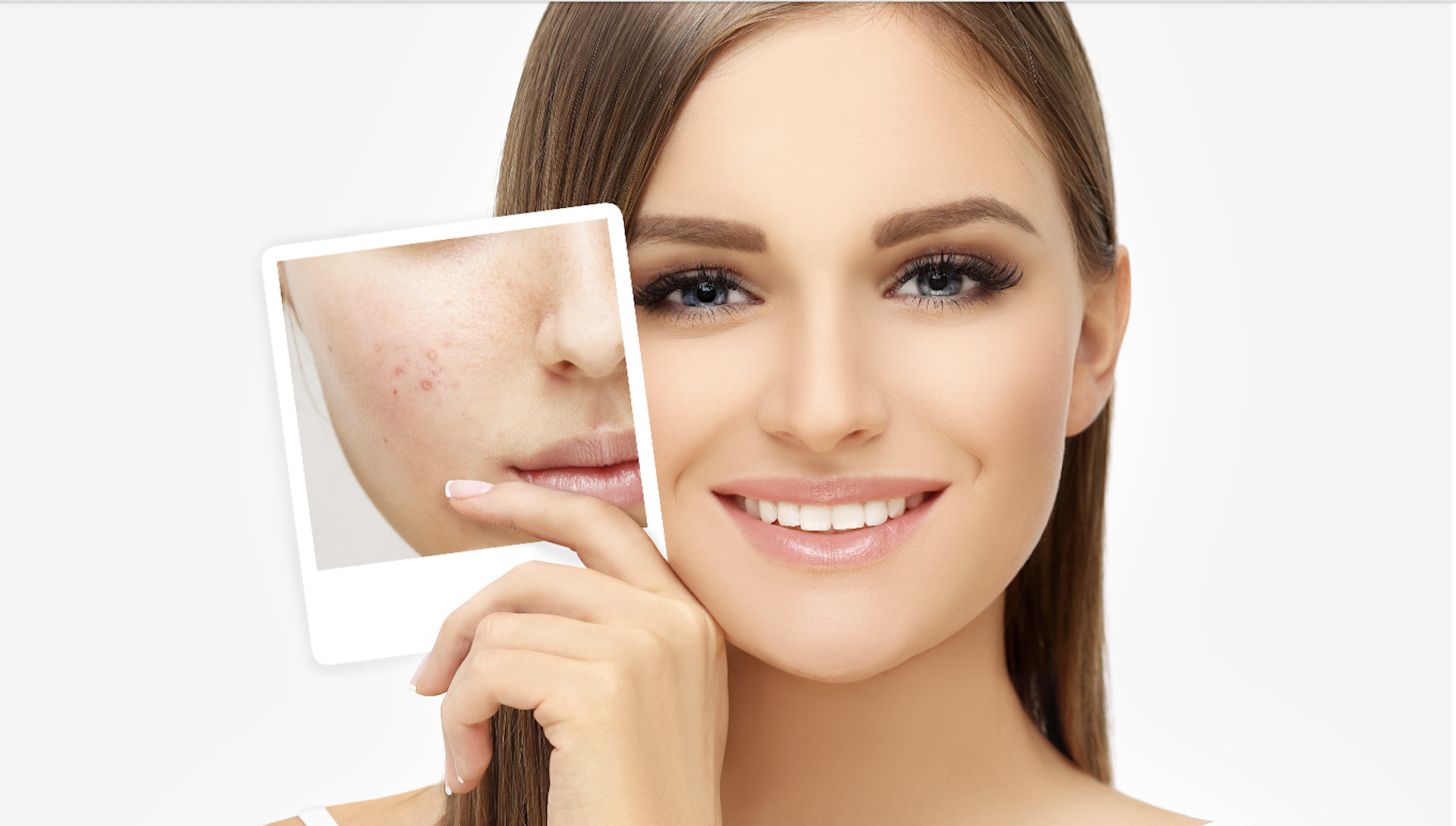 Čo na akné cez noc? Rýchle tipy pre čistejšiu pleť do rána