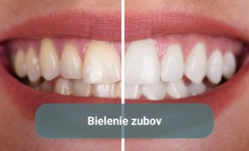 Bielenie zubov Exclusive
